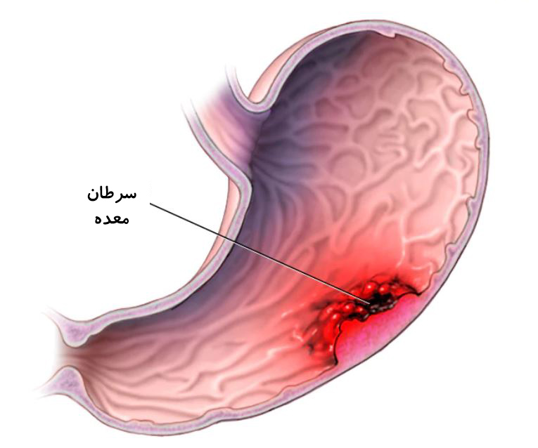 سرطان معده
