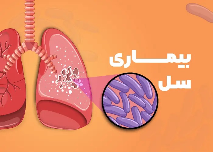 Tuberculosis