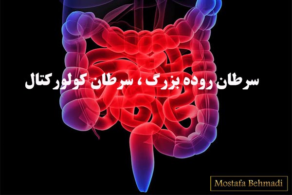سرطان روده بزرگ 